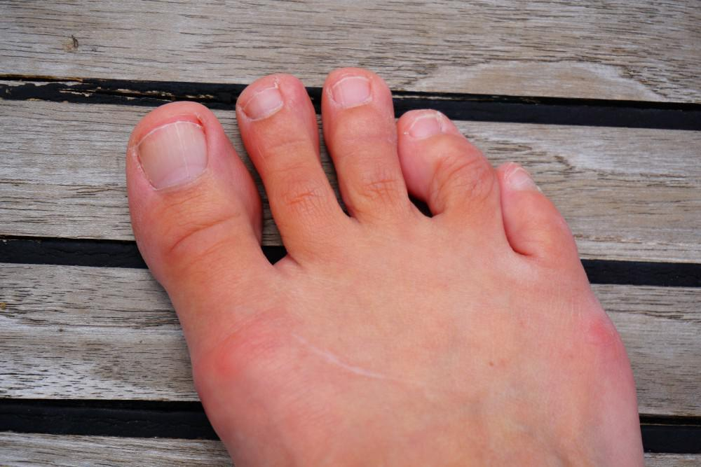 What Can Cause Hammertoe and What Are the Treatment Options?