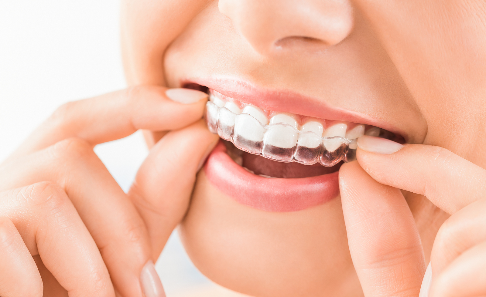 Excellent Dental Health Benefits of Clear Aligners 