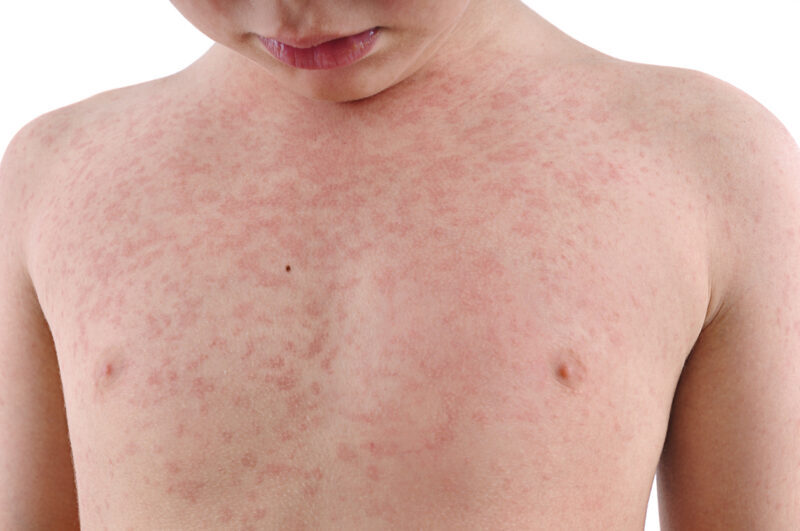 Types of Skin Allergies: Symptoms and Treatment