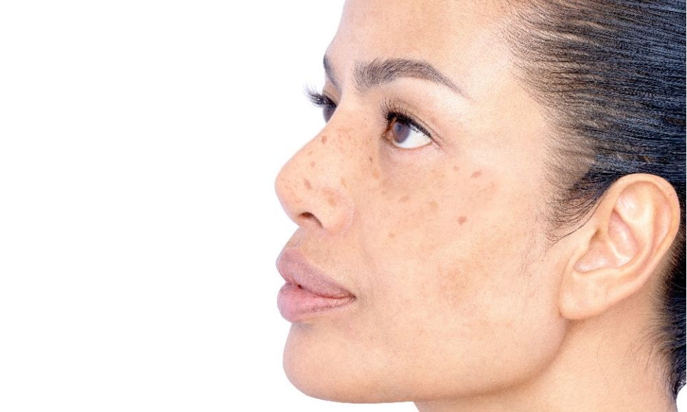A Clearer Path: Strategies for Pigmentation Removal