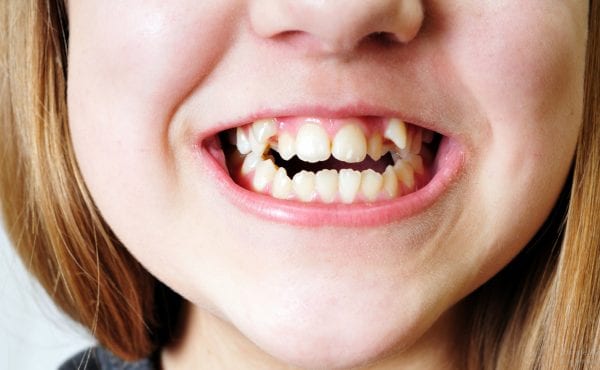 Common Orthodontic Problems and How to Fix Them