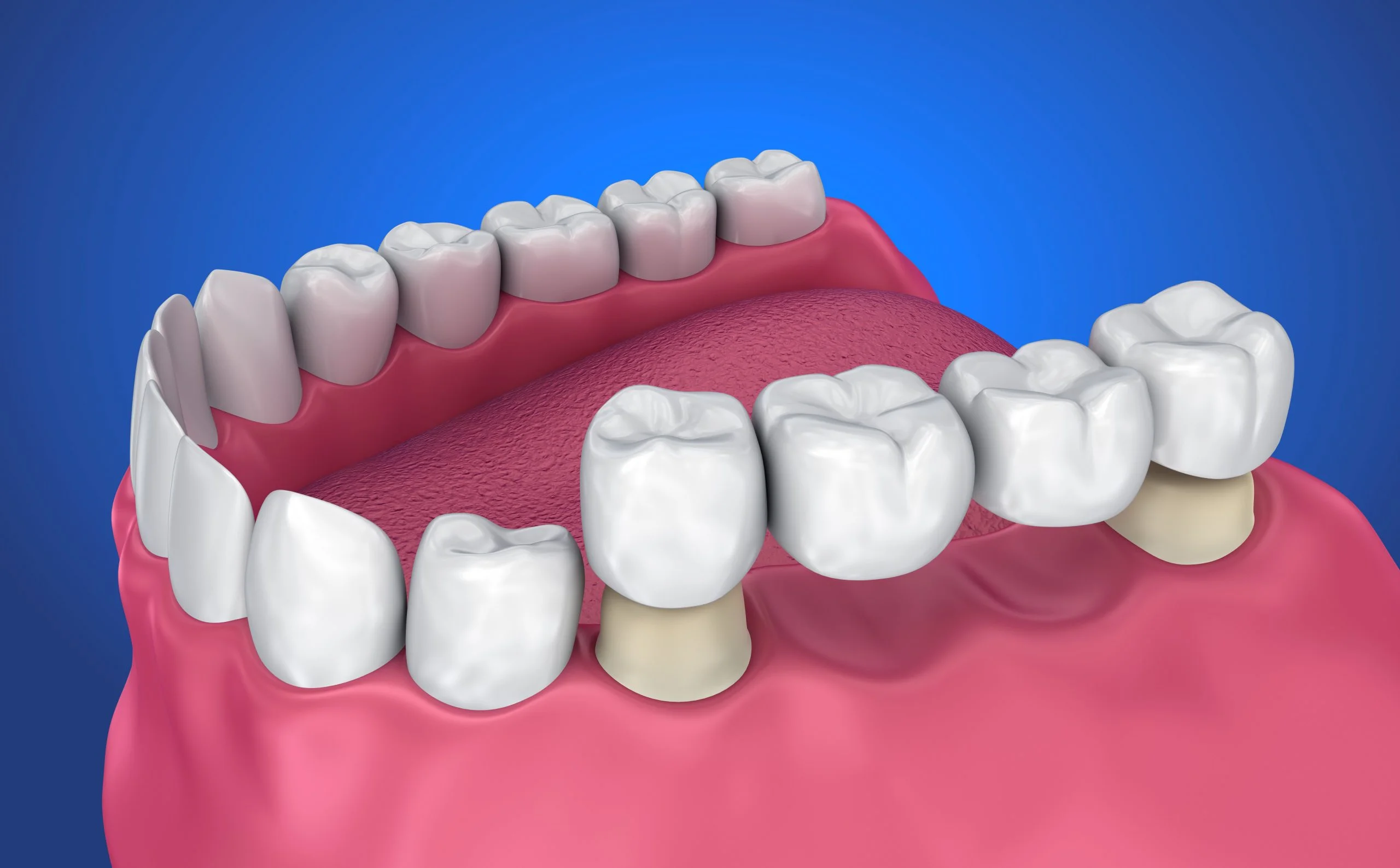 Types of Fixed Dental Bridges: Which One Is Right for You?