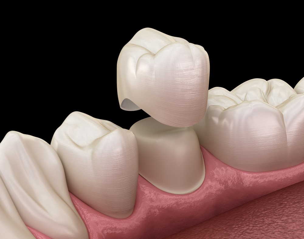 Dental crowns – All you need to know 