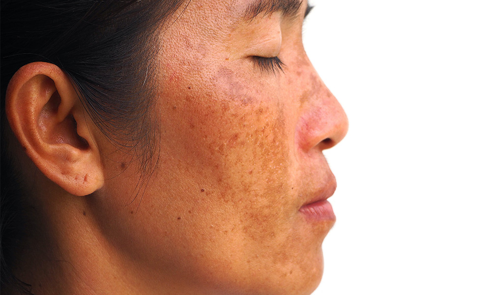 Zapping Away Pigmentation with Laser Treatment