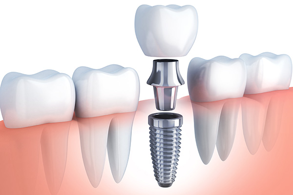 Improving Your Smile after Losing Teeth with Dental Implants in Grand Valley 