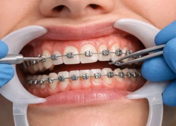 Thinking about Damon Braces? Here is What You Should Know
