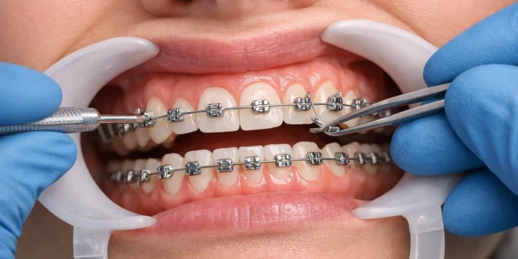 Thinking about Damon Braces? Here is What You Should Know