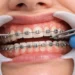 Thinking about Damon Braces? Here is What You Should Know